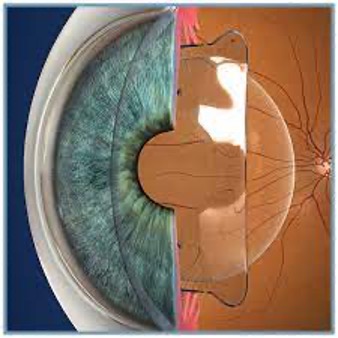 Eye(cataract)