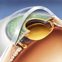 Eye(cataract)