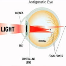 Eye(cataract)