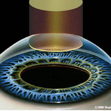 Eye(cataract)