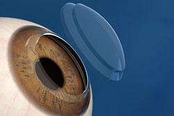 Eye(cataract)