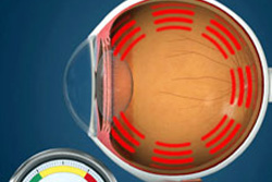 Eye(cataract)